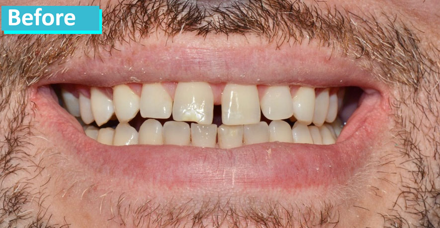 Sky Dental NYC patient 1's teeth before cosmetic bonding. Teeth are worn, irregularly shaped, slightly discolored and widely spaced.
