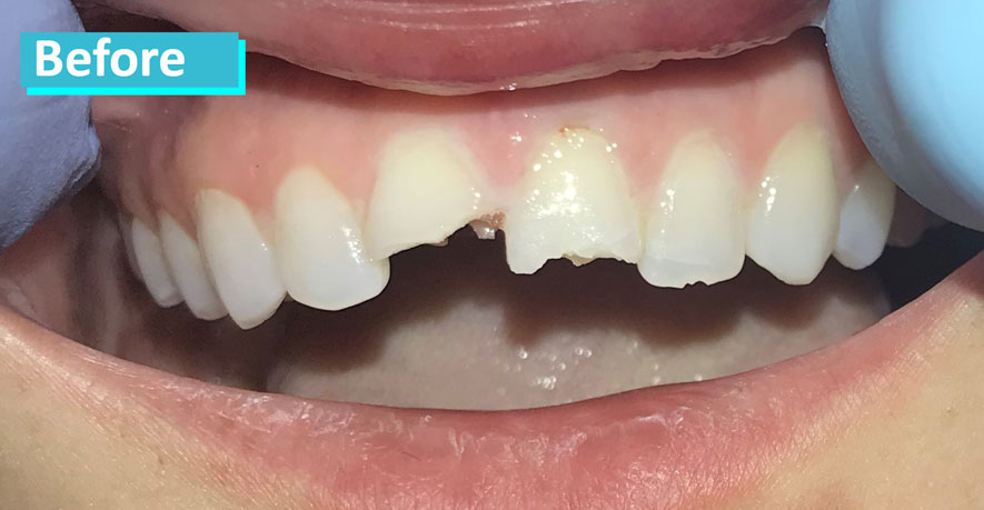 Sky Dental NYC patient 2's teeth before cosmetic bonding. Two front teeth are broken, bottom half of each tooth missing. All of the patient's teeth are very slightly discolored.