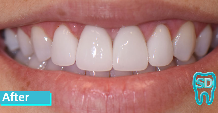 Sky Dental NYC patient 2's teeth after cosmetic bonding. Broken teeth are repaired, and her smile looks perfect.