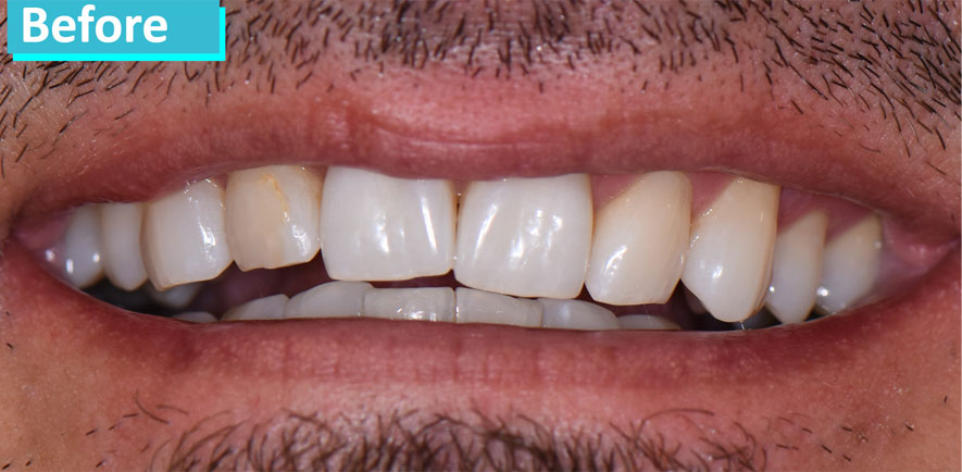 Sky Dental, patient 1 before Teeth Whitening in NYC. Lateral incisors and canines are dark yellow, almost brownish.