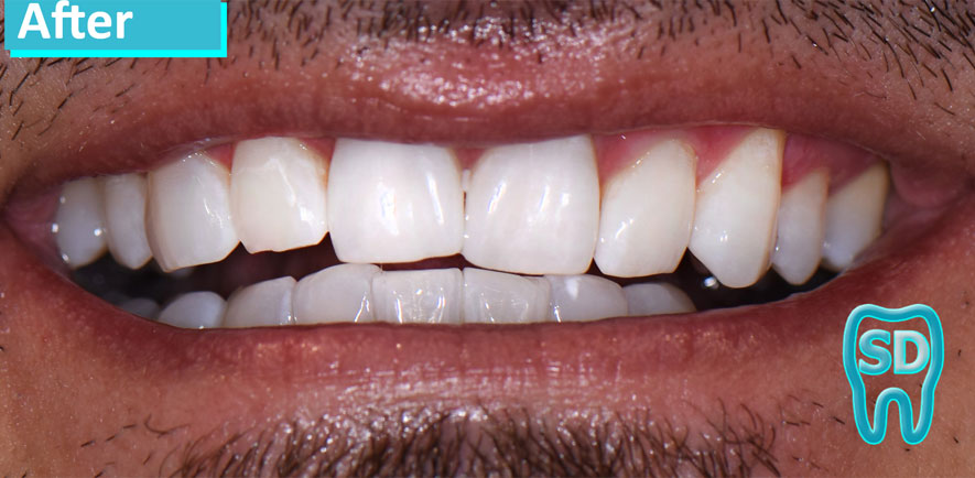 Sky Dental, patient 1 after Teeth Whitening in NYC. Teeth are much whiter and relatively uniform in color.