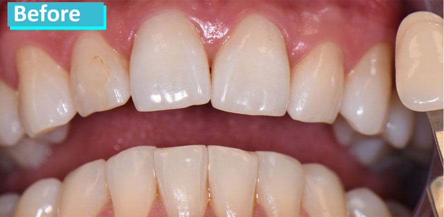 Sky Dental, patient 2 before Teeth Whitening in NYC. Teeth are brownish, especially top lateral incisors and all visible bottom teeth.
