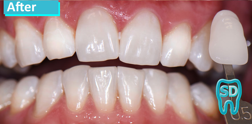 Sky Dental, patient 2 after Teeth Whitening in NYC. Teeth are much whiter, and relatively uniform in color.