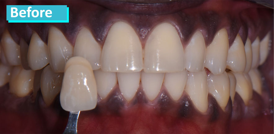 Sky Dental, patient 3 before Teeth Whitening in NYC. Teeth show a uniform discoloration typically associated with aging.