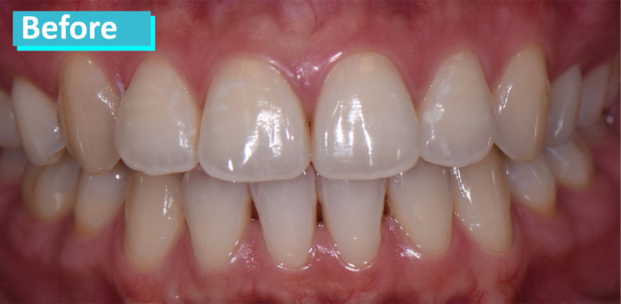 Sky Dental, patient 6 before Teeth Whitening in NYC. All teeth have some discoloration, especially the bottom canines.