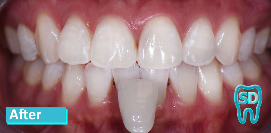 Sky Dental, patient 6 after Teeth Whitening in NYC. Teeth are much whiter, dramatic improvement overall.