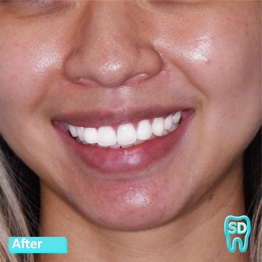 Sky Dental, patient 1 after Teeth Whitening and Invisalign in NYC. Teeth are pearly white and perfectly aligned!