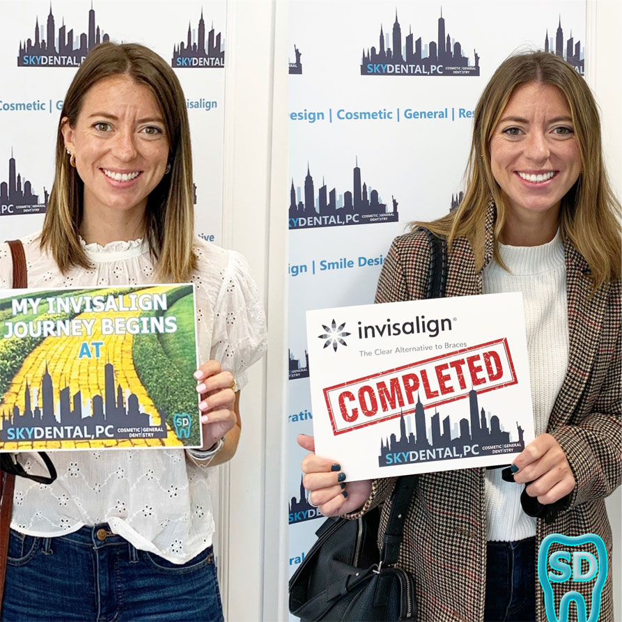 Sky Dental, patient 2 before and after Teeth Whitening and Invisalign in NYC. Teeth are pearly white and perfectly aligned!