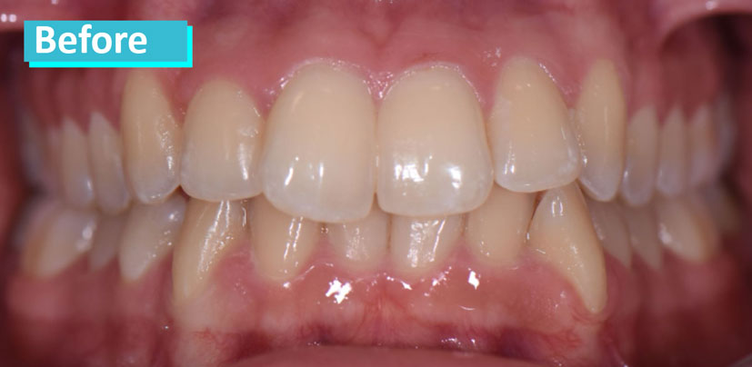 Sky Dental Invisalign patient 3's teeth before. They are slightly crooked and angled inward in some places.