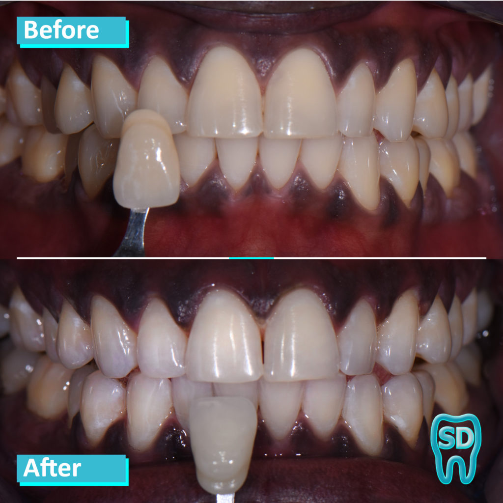 Patient 3 before and after teeth whitening in NYC. Some slight discoloration remains in spots, but overall teeth are much whiter.