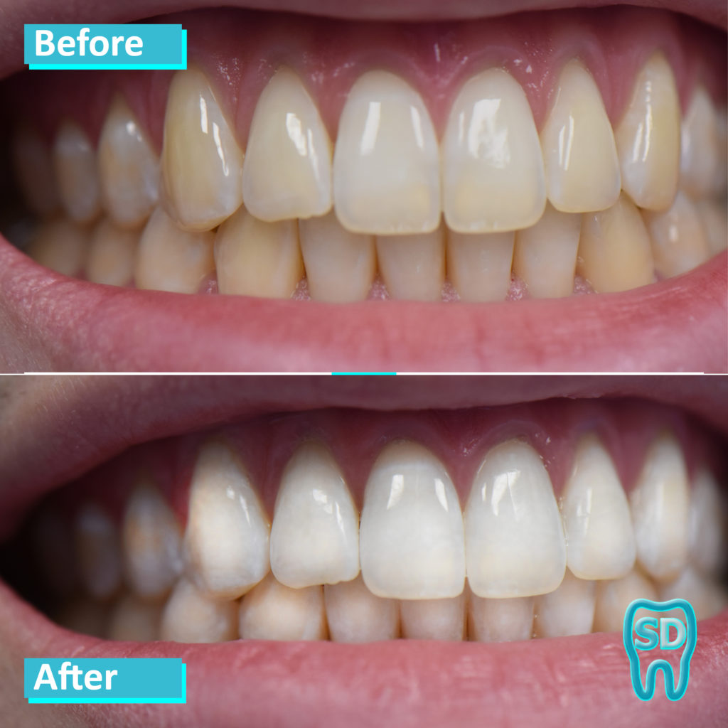 Patient 5 before and after whitening. Teeth were discolored, especially lat incisors and canines. Teeth are much whiter after. 