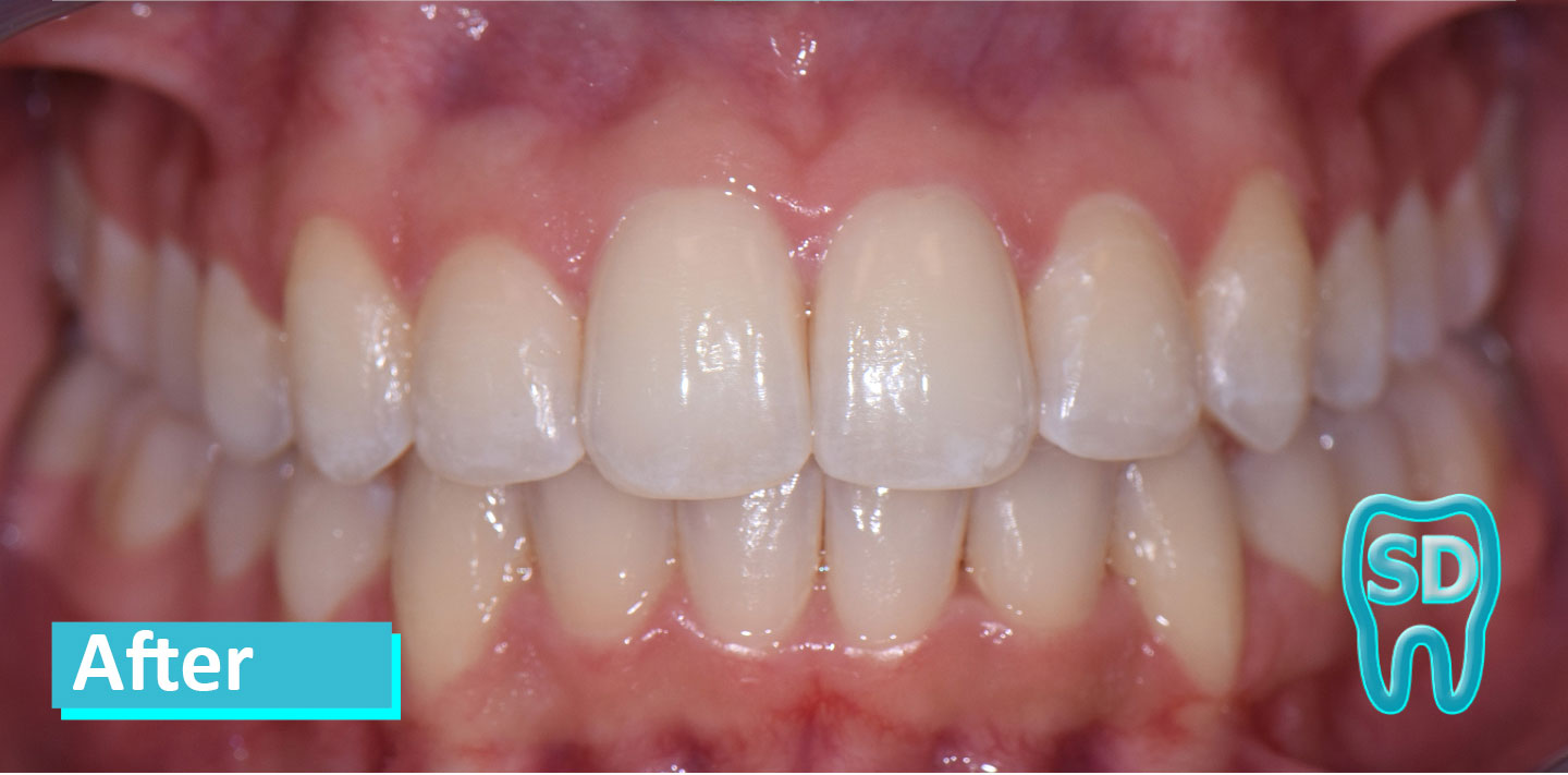 Sky Dental Invisalign and Zoom Whitening patient 3's teeth after. Teeth look perfect!