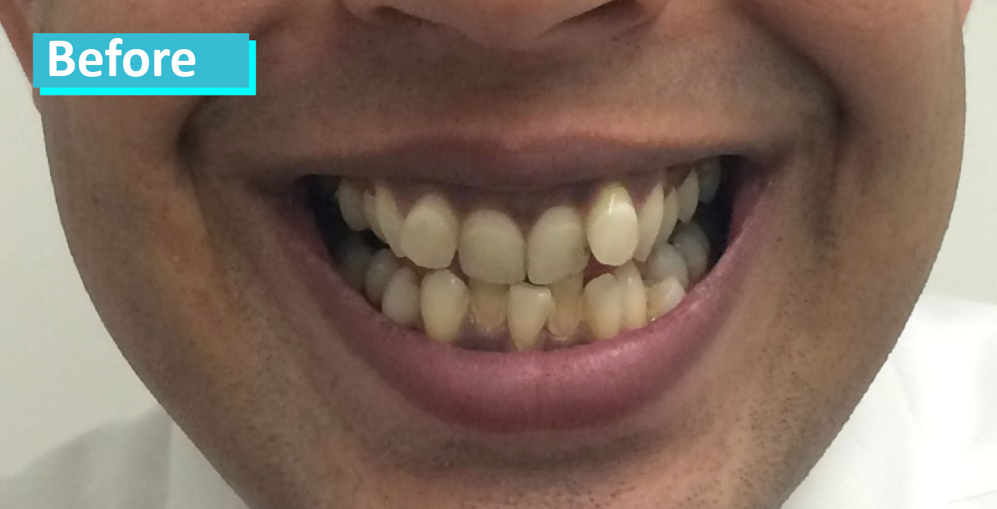 Sky Dental Invisalign patient 2's teeth before. They are quite crooked and angled in various directions.