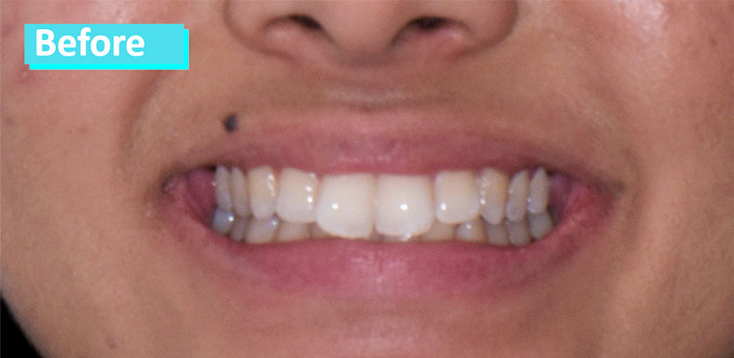 Sky Dental Invisalign patient 1's teeth before. They are fairly straight but appear just slightly crowded.