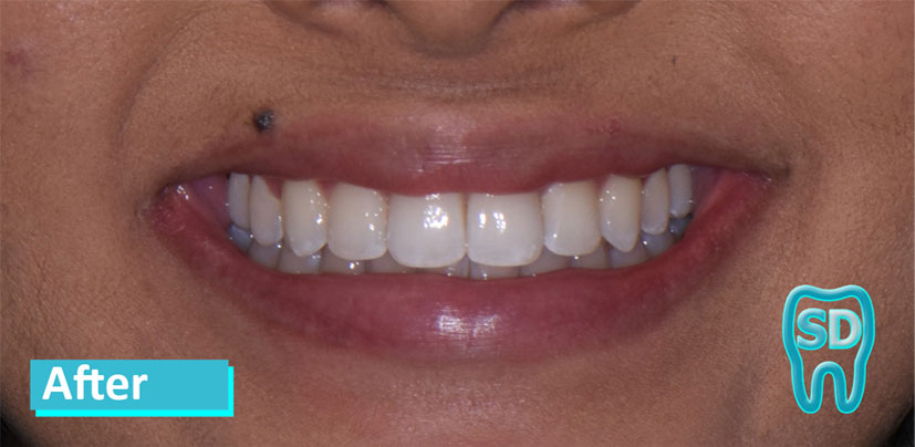 Sky Dental Invisalign patient 1's teeth after. Teeth appear perfect now.