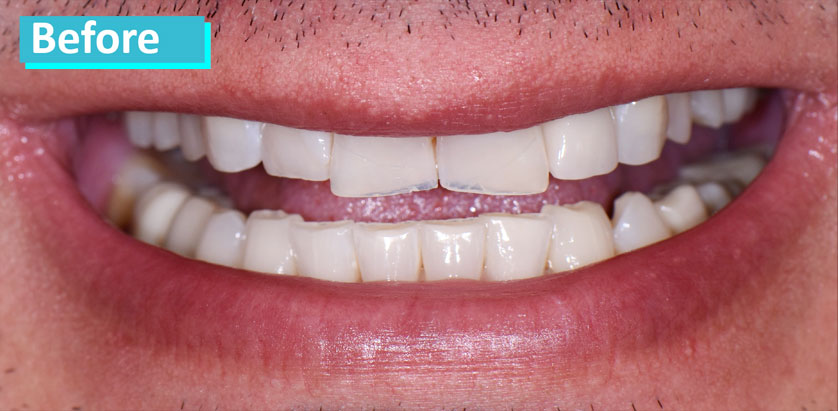 Patient 2's teeth before porcelain veneer. Teeth are worn, square-shaped, and ever-so-slightly discolored.