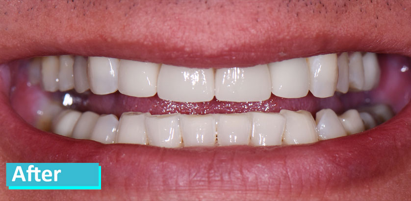 Patient 2's teeth after porcelain veneer. Teeth appear whiter, with a more natural, rounded shape to each tooth's edge.