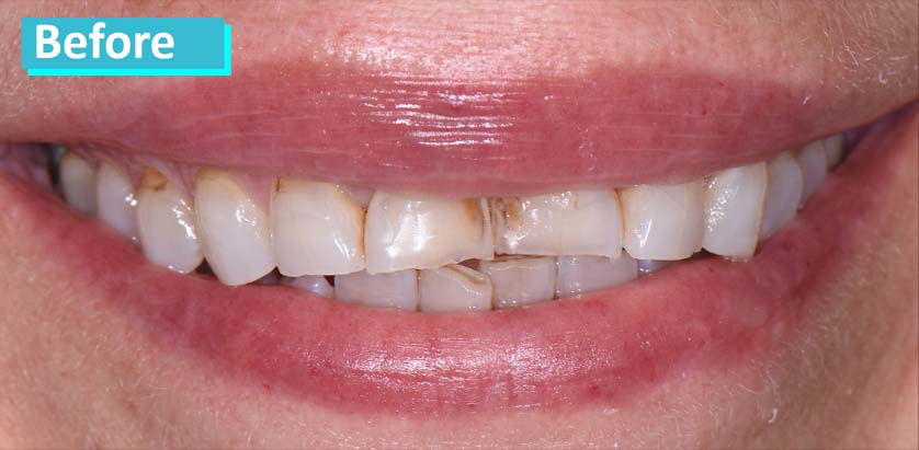 Sky Dental, patient 12 before Dental Crowns in NYC. Teeth uneven.