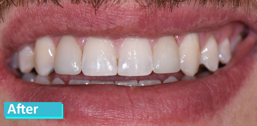 Patient 3's teeth after porcelain veneer. Teeth are noticeably whiter, with less space between them, and appear 