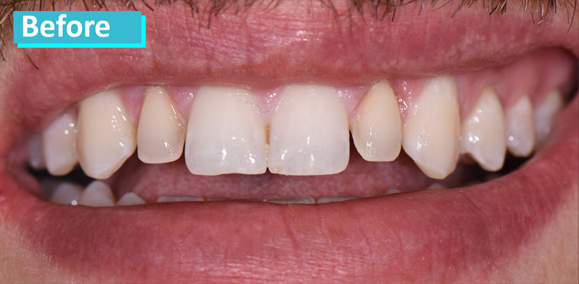 Patient 3's teeth before porcelain veneer. Teeth show wear and tear and some discoloration.