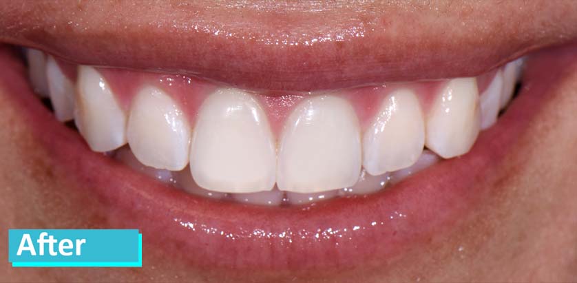 Sky Dental, patient 12 after whitening