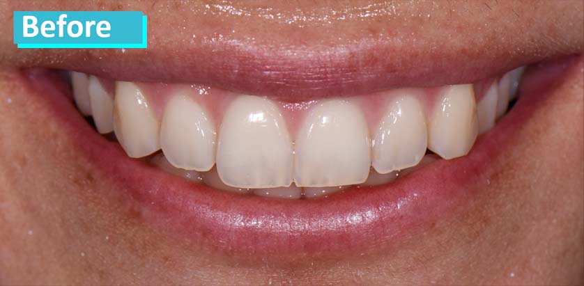 Sky Dental, patient 12 before whitening