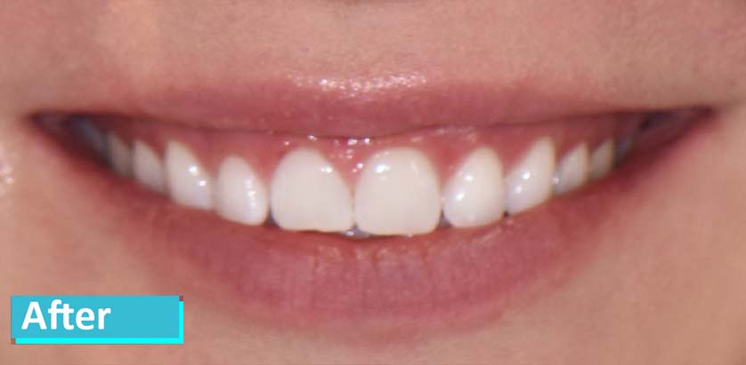 Sky Dental, patient 13 after whitening