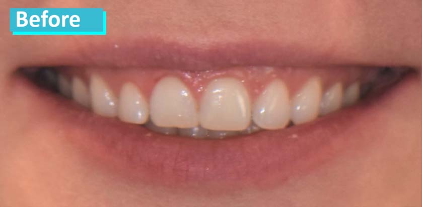 Sky Dental, patient 13 before whitening