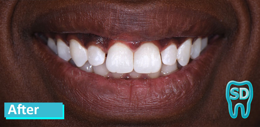 Sky Dental, patient 11 after Teeth Whitening in NYC. Teeth are whiter but show some wear that wasn't visible before.