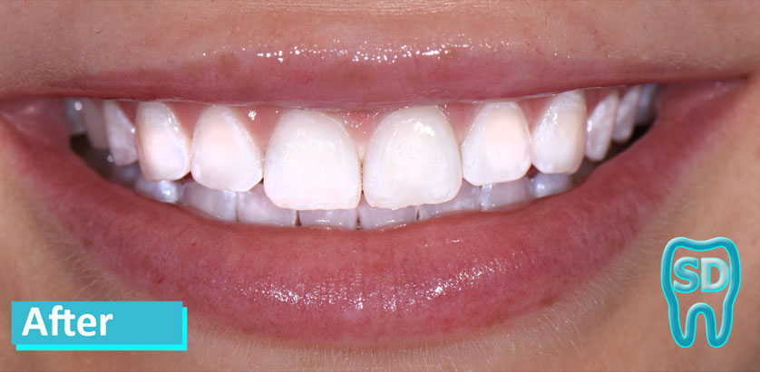 Sky Dental, patient 10 after Teeth Whitening in NYC. Teeth are whiter but show some wear that wasn't visible before.