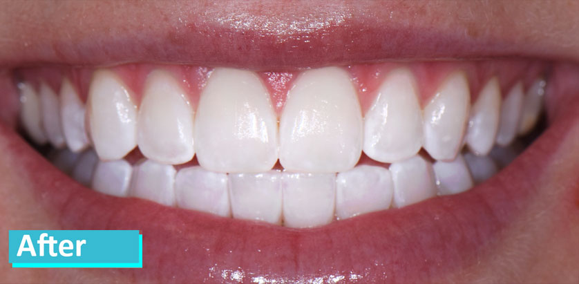 Sky Dental, patient 9 after Teeth Whitening in NYC. Teeth are whiter but show some wear that wasn't visible before.