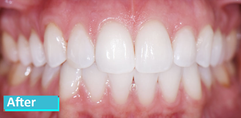 Sky Dental, patient 8 after Teeth Whitening in NYC. Vast improvement, teeth are much whiter.