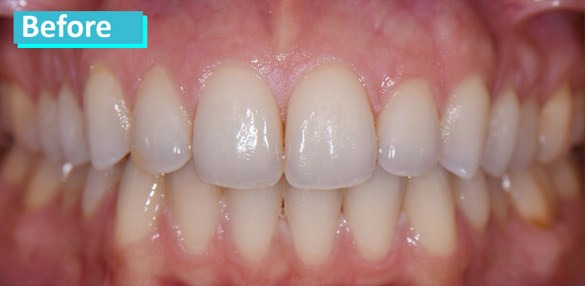 Sky Dental, patient 8 before Teeth Whitening in NYC. Teeth show a mild uniform discoloration, yellowing more towards the gum line.