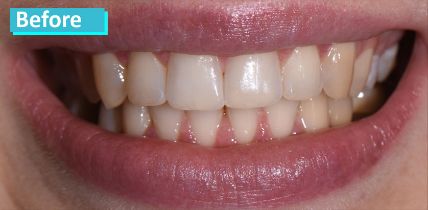 Sky Dental, patient 7 before Teeth Whitening in NYC. Teeth show a uniform discoloration.