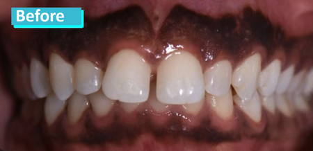 Patient 1's teeth before porcelain veneers. Teeth exhibit damage and discoloration and are slightly misaligned.