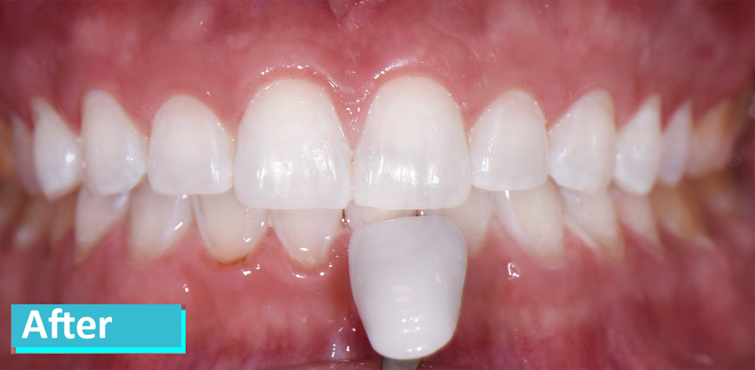 Zoom Whitening Case After
