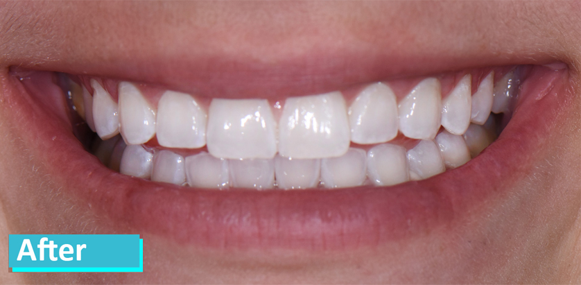 Zoom Whitening Case after