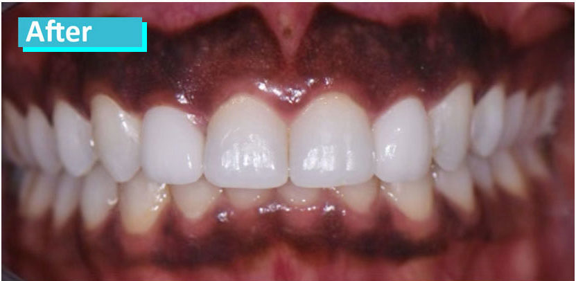 Patient 1's teeth after porcelain veneers. Teeth now appear bright white, straight, and uniformly shaped.