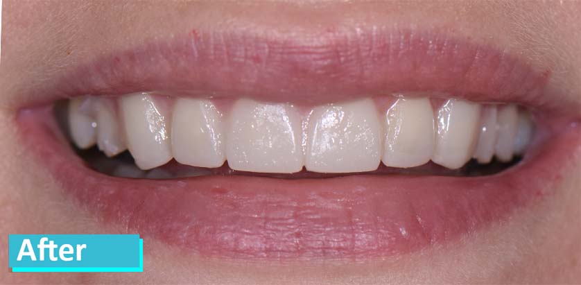 Patient teeth after crowns