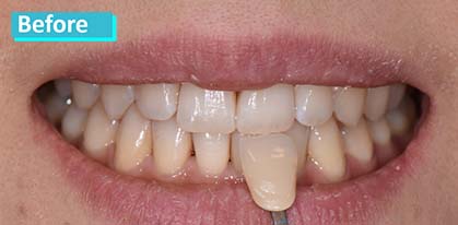 Sky Dental, patient 16 before whitening