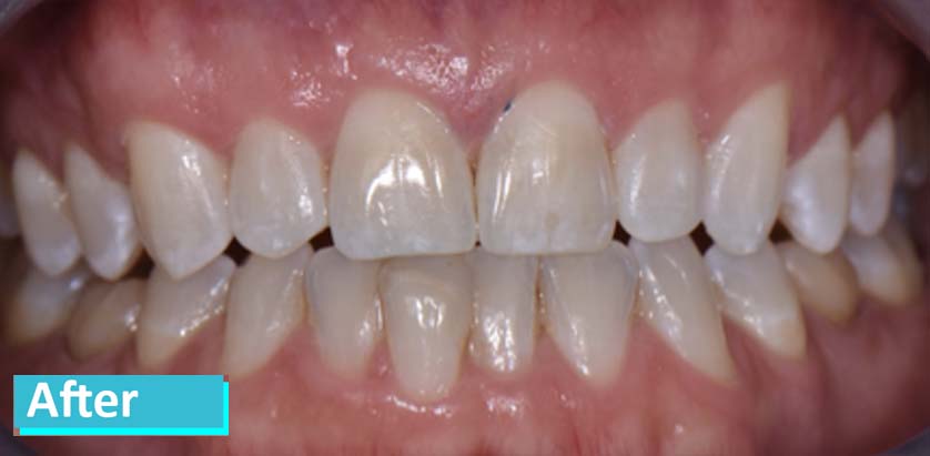 Patient teeth after Invisalign