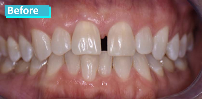 Patient teeth before Invisalign